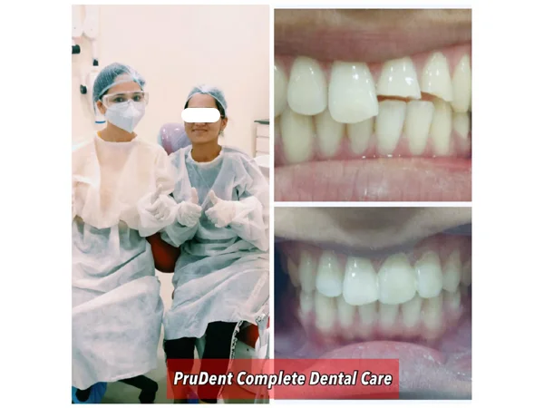 Before and After