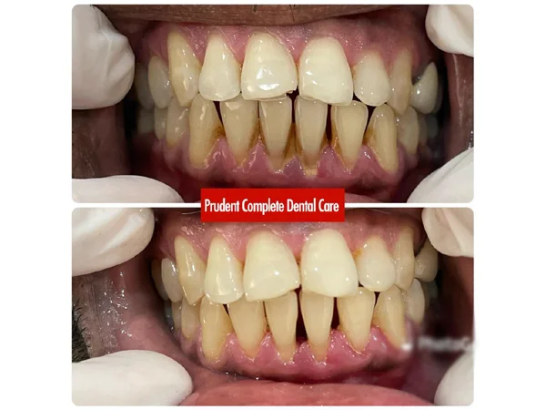 Before and After