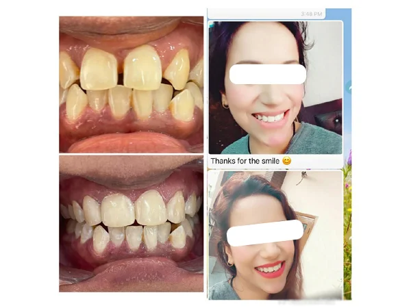 Before and After