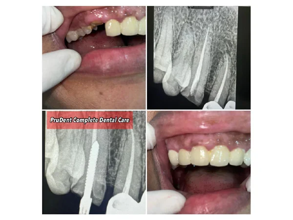 Before and After