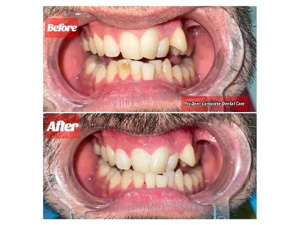 Before and After
