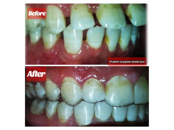 Before and After