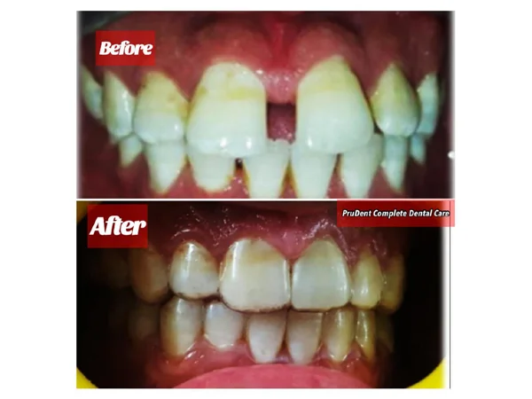 Before and After