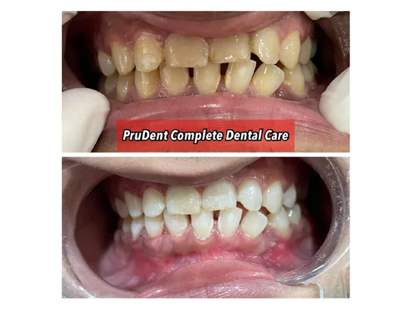 Before and After