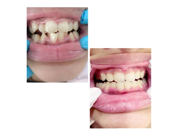 Before and After