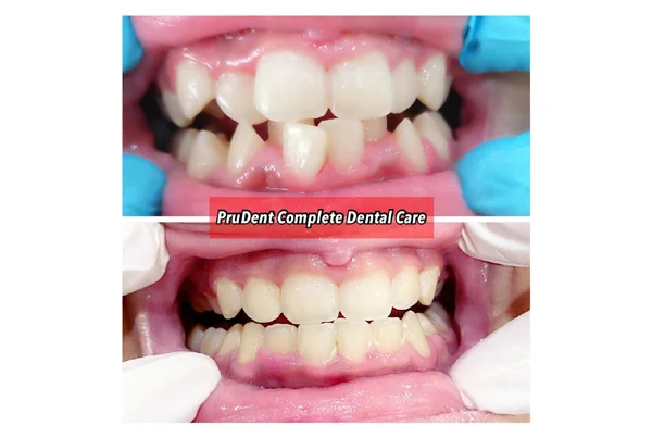 Before and After