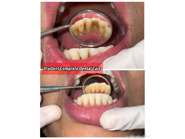 Before and After