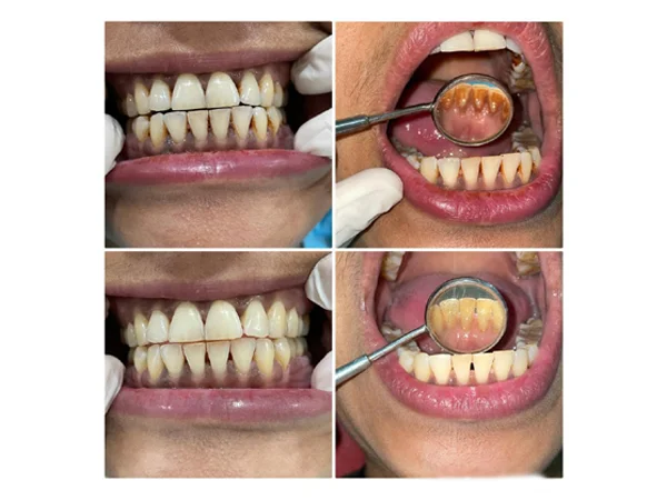 Before and After