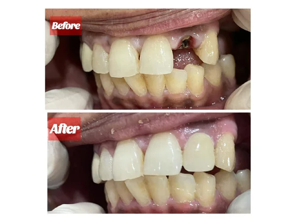 Before and After