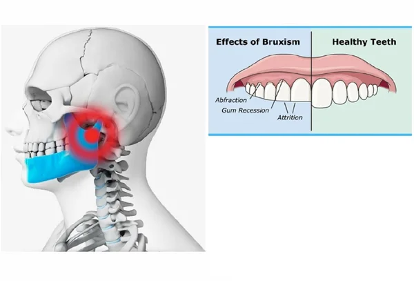 TMJ and Bruxism