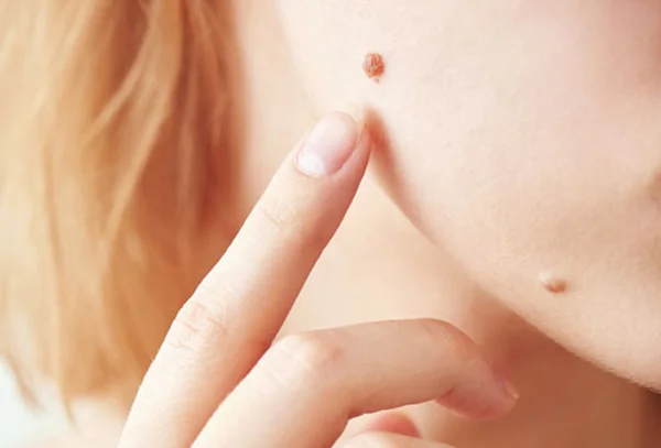 Mole / Wart Removal